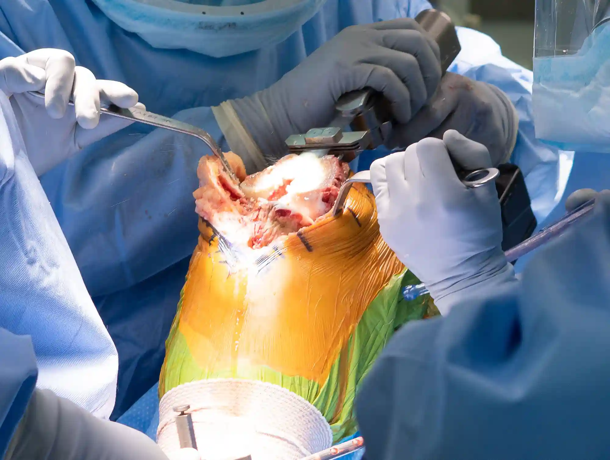 جراحی تعویض مفصل زانو