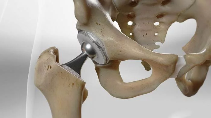 جراحی تعویض مفصل لگن
