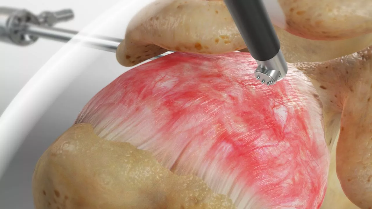 پارگی کپسول مفصل شانه