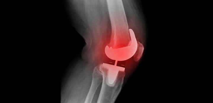 عوارض بعد از عمل تعویض مفصل زانو