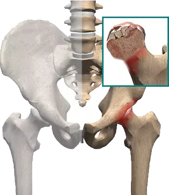 پوکی استخوان و تاثیر آن بر زانو و لگن
