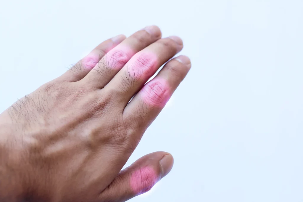 روماتوئید آرتریت