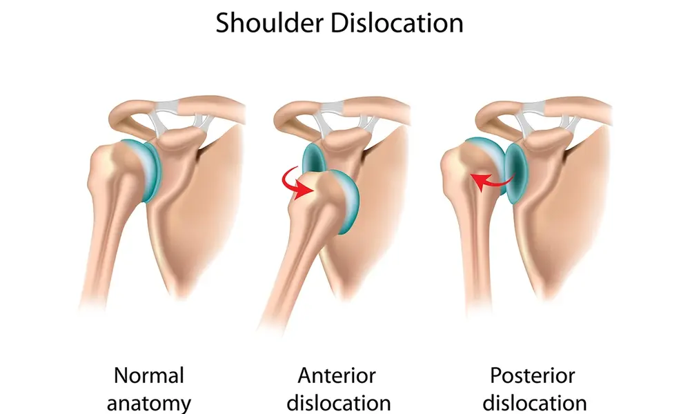 دررفتگی مفصل شانه