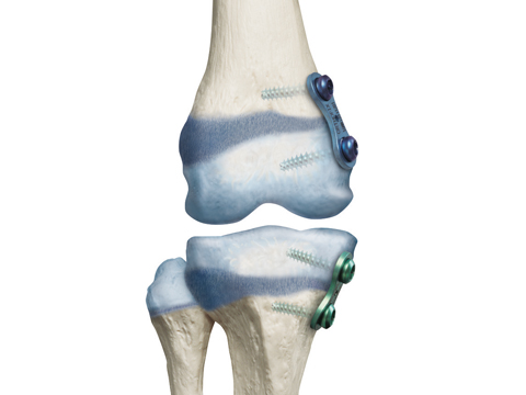 جراحی اپی فیزیودز